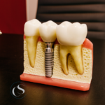implantes dentales en carabanchel