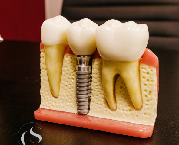 implantes dentales en carabanchel