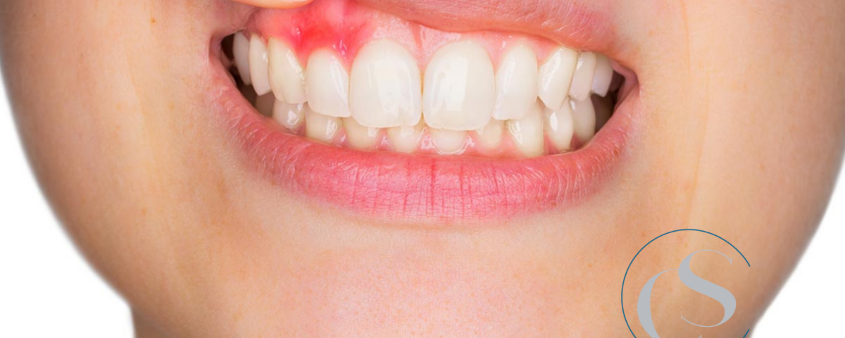 flemón dental