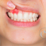 flemón dental