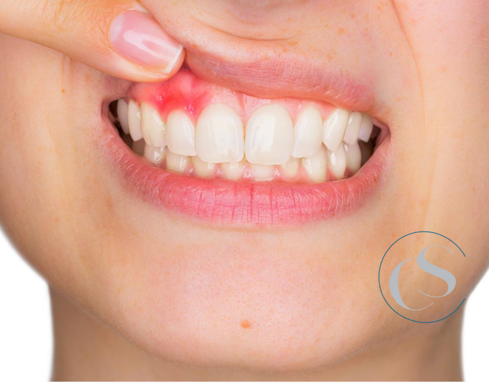 flemón dental