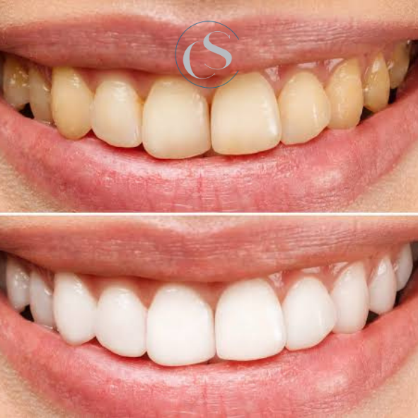 alimentos para blanquear los dientes