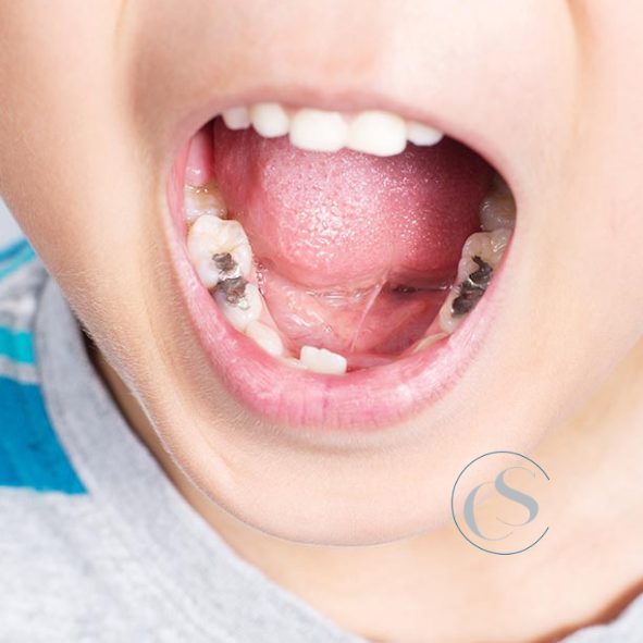 evitar las caries en niños