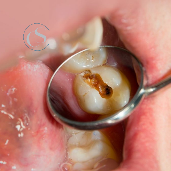 evitar las caries en niños