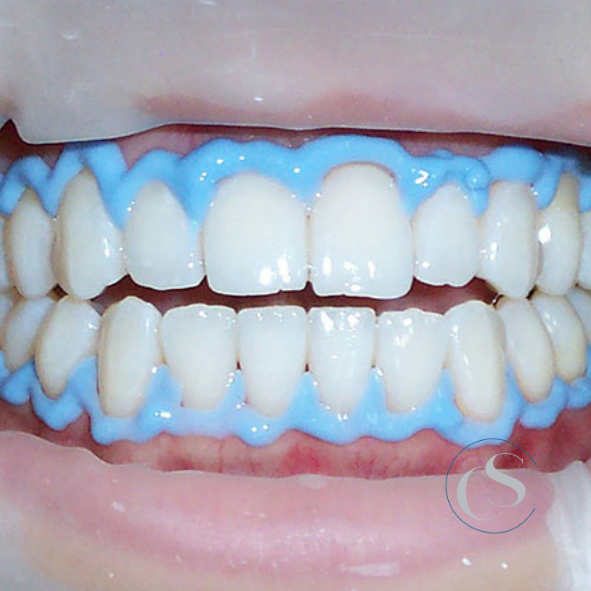 Blanquea tus dientes en Carabanchel