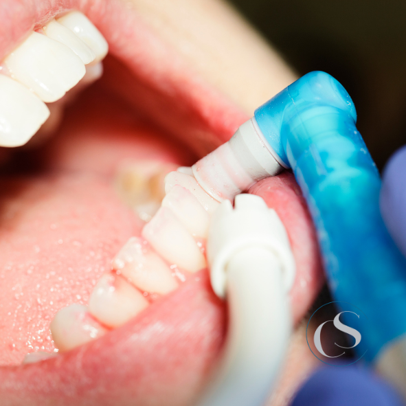 limpieza dental profesional