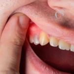 cómo se trata un flemón dental