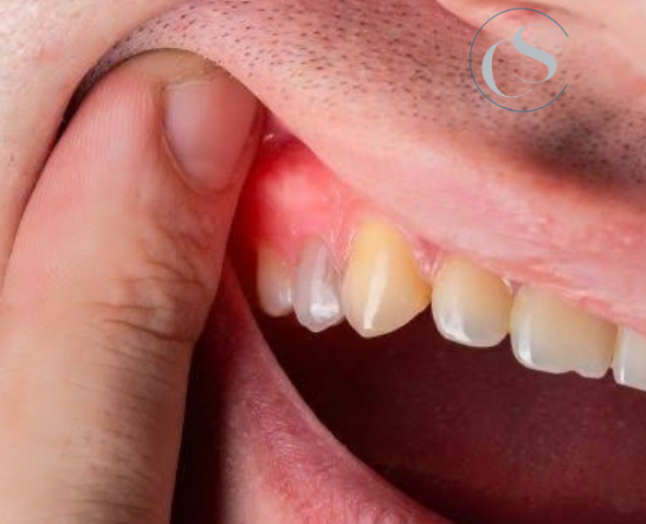 cómo se trata un flemón dental