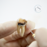 Endodoncia en Madrid