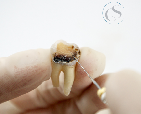 Endodoncia en Madrid