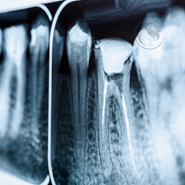 Endodoncia en Madrid