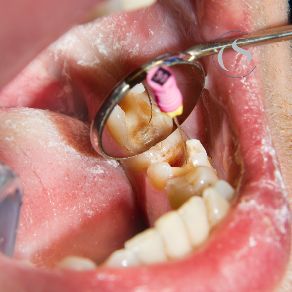 Endodoncia en Madrid